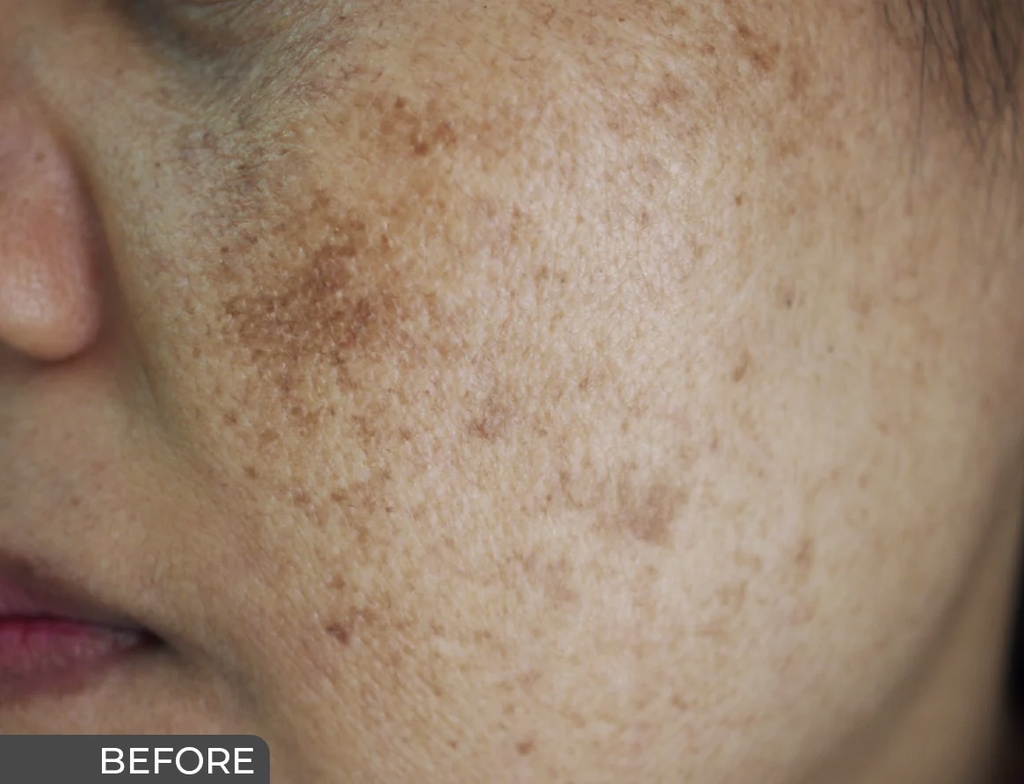 Ceuticoz/ Curalite Lightening Cream 50g: سيتيكوز كريم علاجي للتصبغات وتوحيد لون البشرة