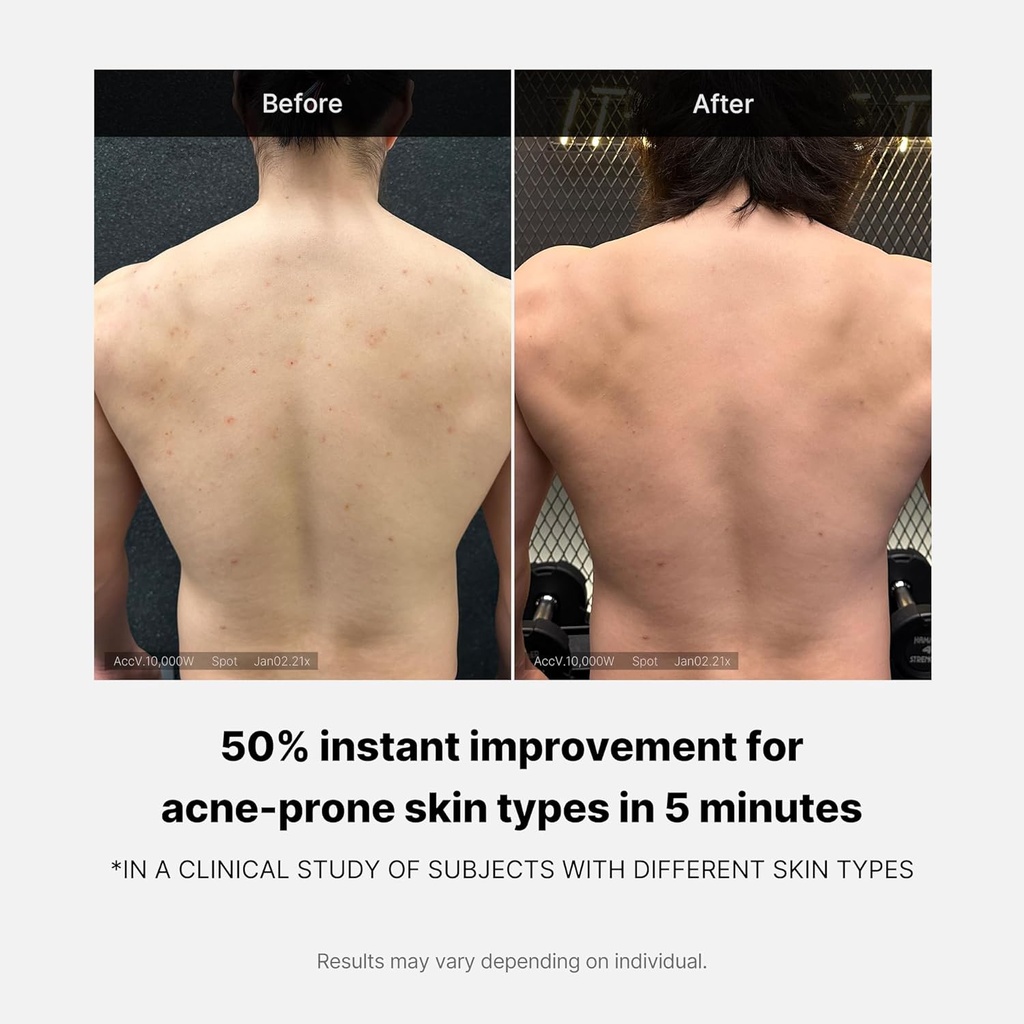 MediCube/ Red Acne Body Wash 400g: مديكيوب غسول للجسم لعلاج حب الشباب والحبوب الحمراء