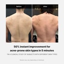 MediCube/ Red Acne Body Wash 400g: مديكيوب غسول للجسم لعلاج حب الشباب والحبوب الحمراء