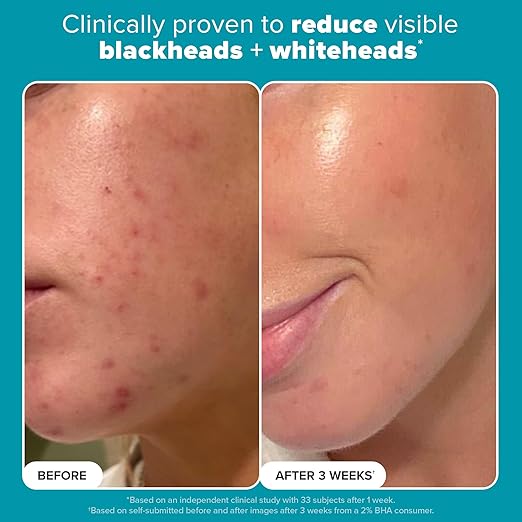 Paula's Choice/ SKIN PERFECTING 2% BHA Liquid Salicylic Acid: محلول السلسلك اسيد من باولا تشويس