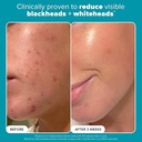 Paula's Choice/ SKIN PERFECTING 2% BHA Liquid Salicylic Acid: محلول السلسلك اسيد من باولا تشويس