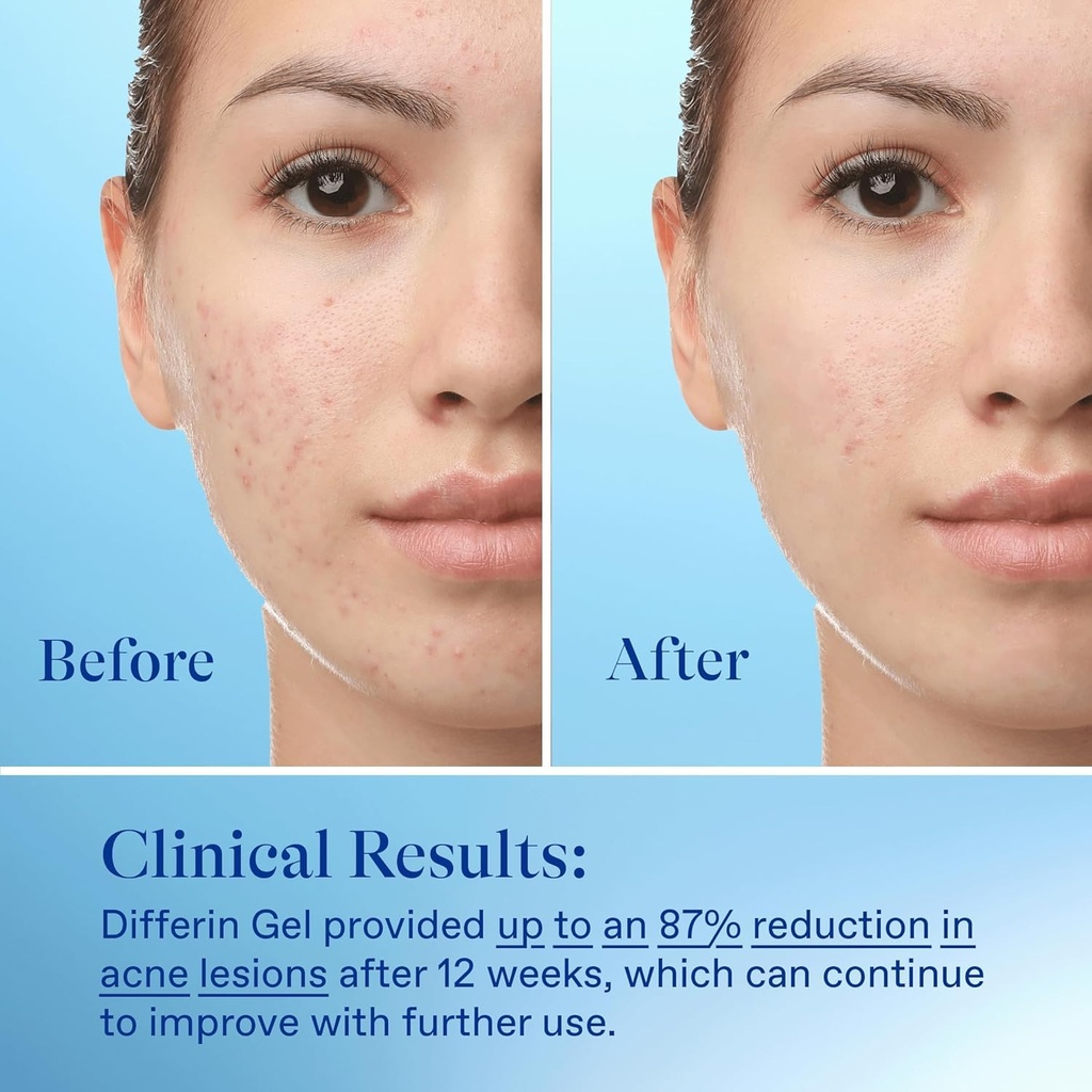 Differin Acne Treatment Gel 0.1% Adapalene 15g: عصارة ديفرين لعلاج حب الشباب