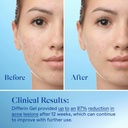 Differin Acne Treatment Gel 0.1% Adapalene 15g: عصارة ديفرين لعلاج حب الشباب